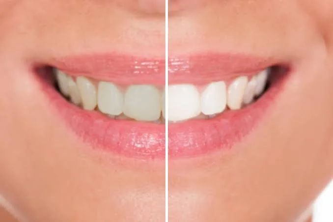 Antes y después de un blanqueamiento dental